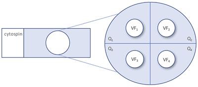 Longitudinal ventricular cerebrospinal fluid profile in patients with spontaneous subarachnoid hemorrhage